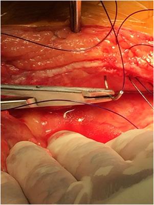 Educating Residents in Abdominal Wall Closure: An Overview